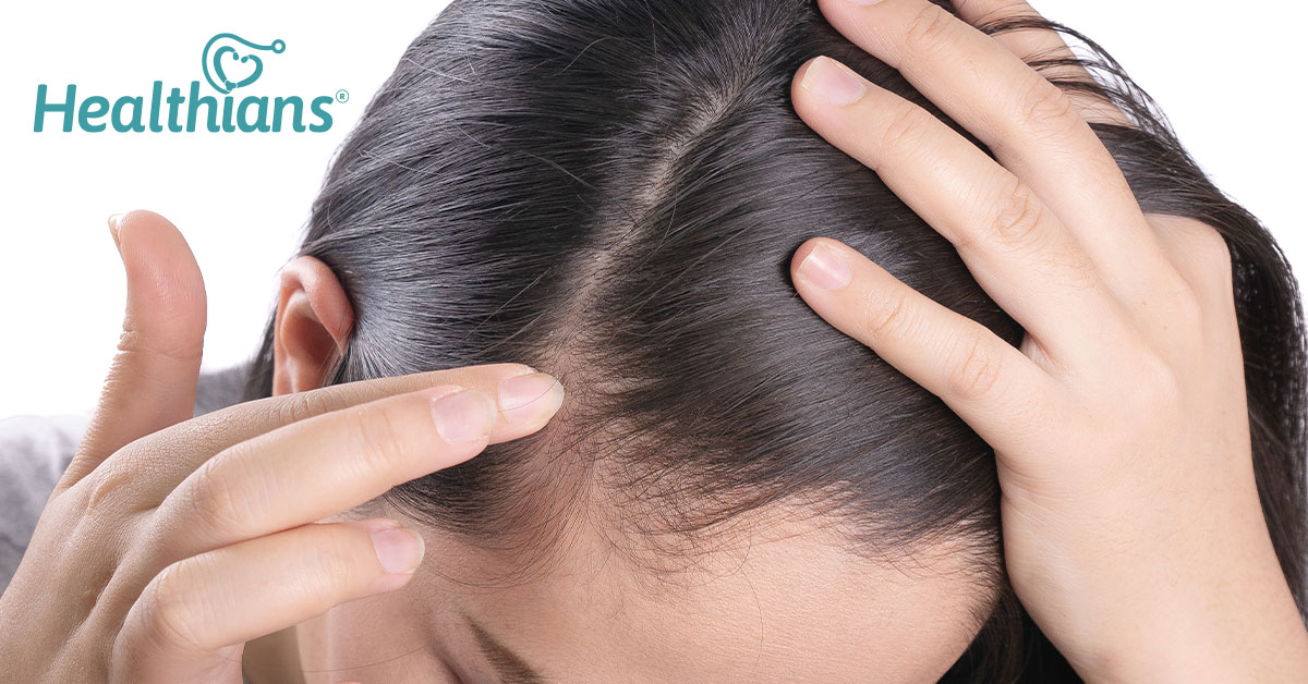 What Is Female Pattern Baldness? Know More About Female Hair Loss! -  HEALTHIANS BLOG