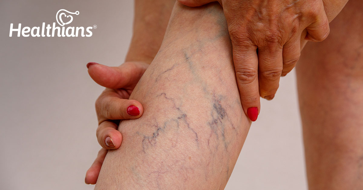 Say ‘Goodbye’ To Varicose Veins With Natural Remedies