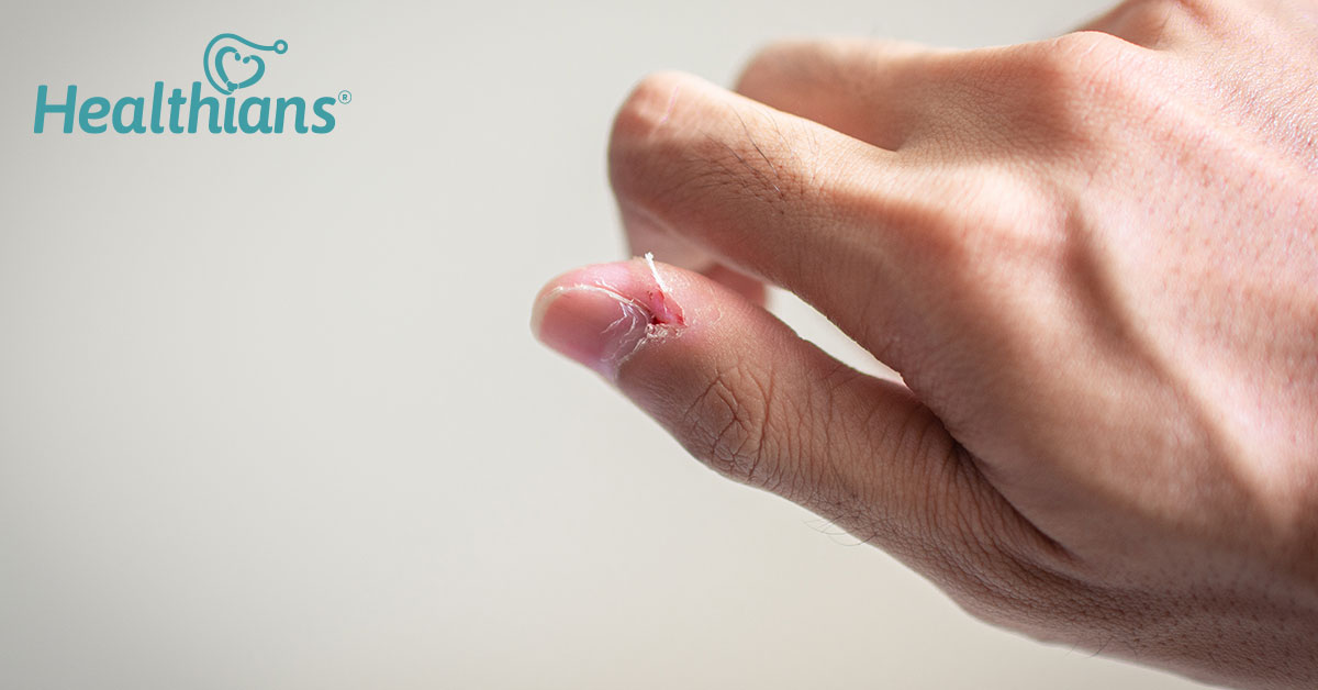 Is The Skin Around Your Nails Peeling? Precautions And Natural Remedies! -  HEALTHIANS BLOG