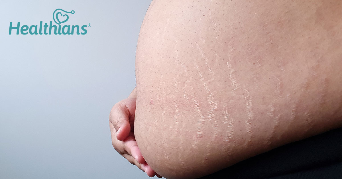 6 Natural Ways to Get Rid of Stretch Marks