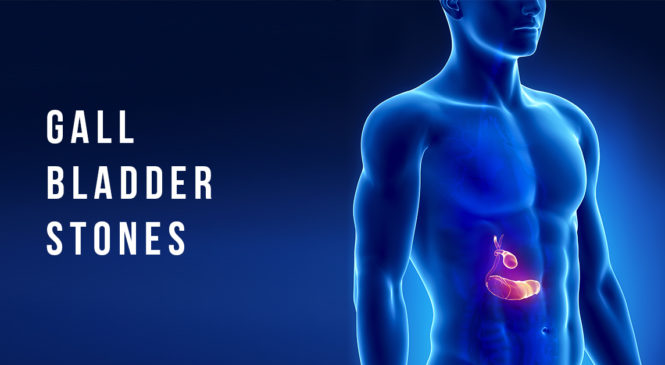 Understanding 5 F’s of Gallbladder Stones