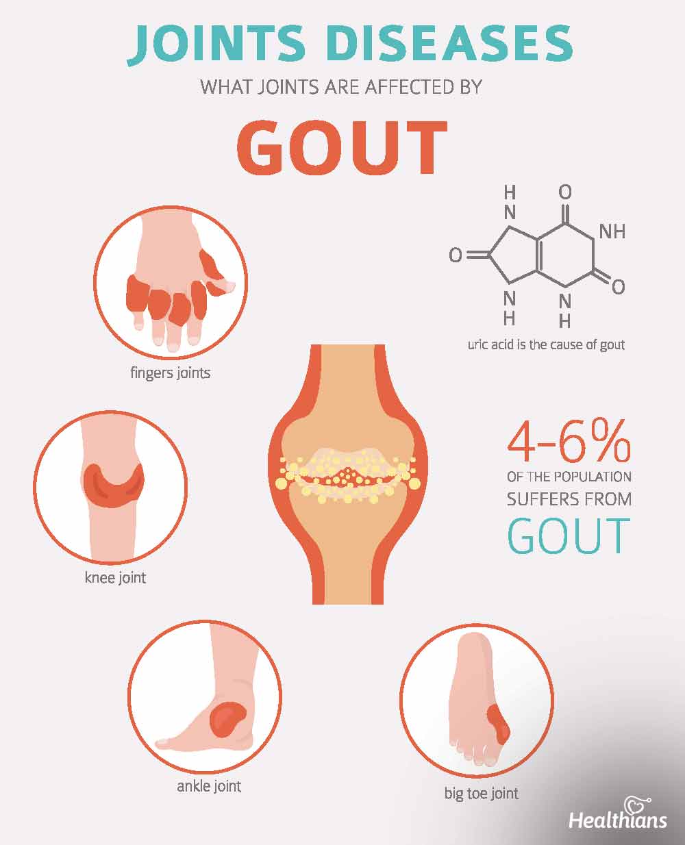 Can Gout Cause An Infection Hot Sex Picture 1472