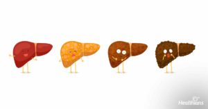 Stages of liver damage - Healthians