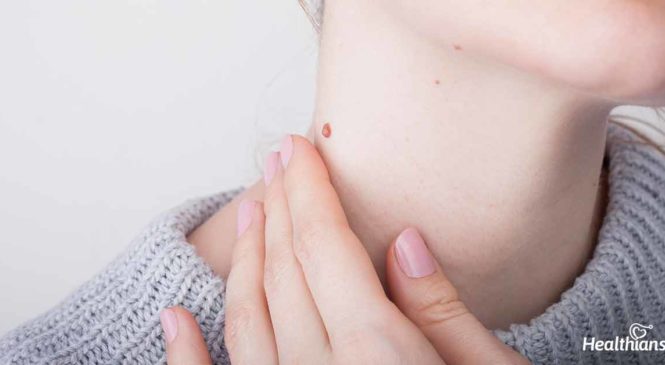 What are skin tags? Are at-home skin tag removal methods safe?