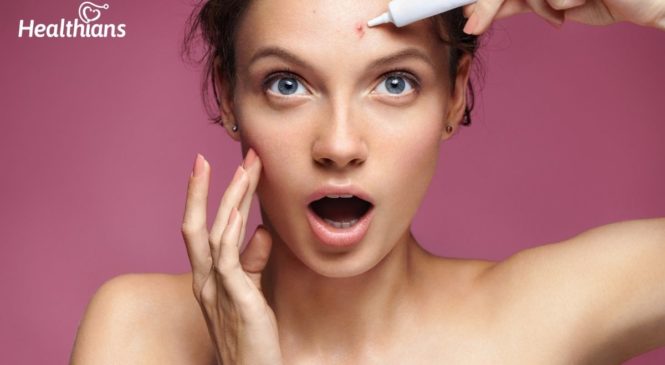 5 signs of adult hormonal acne and their root causes