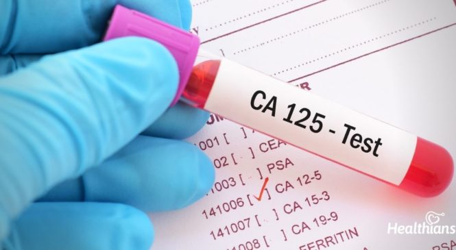 What Do You Need To Know About CA 125 serum test