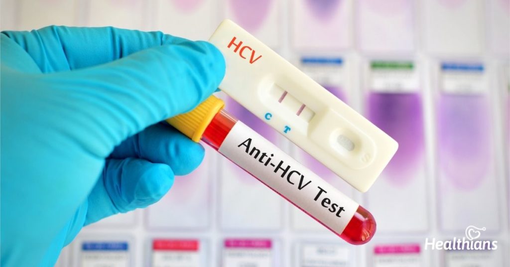 Anti HCV kaç gün sonra?