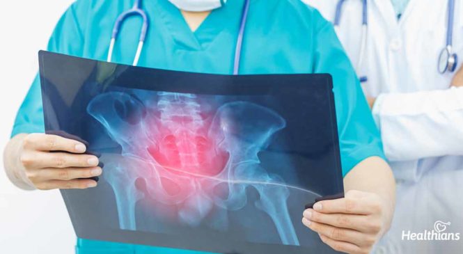All About Bone Cancer: The What, The Why & How To Treat