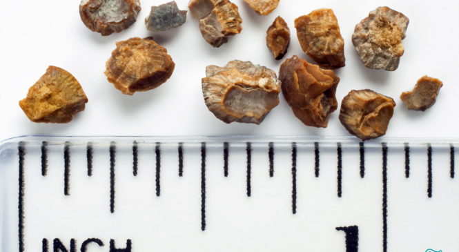5 Essential Dietary Habits For Prevention Of Kidney Stones