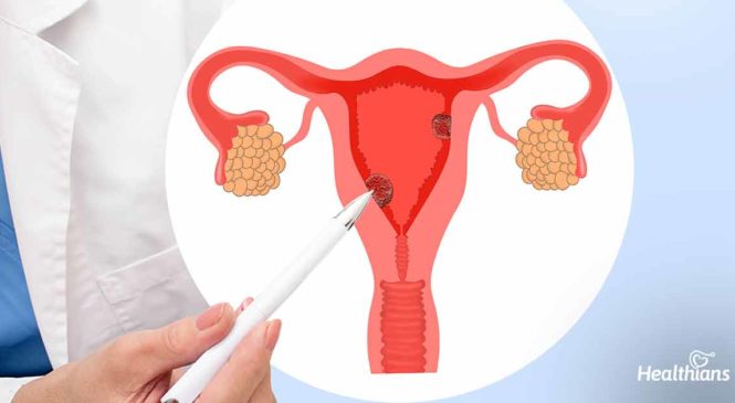 Cervical Cancer: Causes, Symptoms, Treatment & Prevention