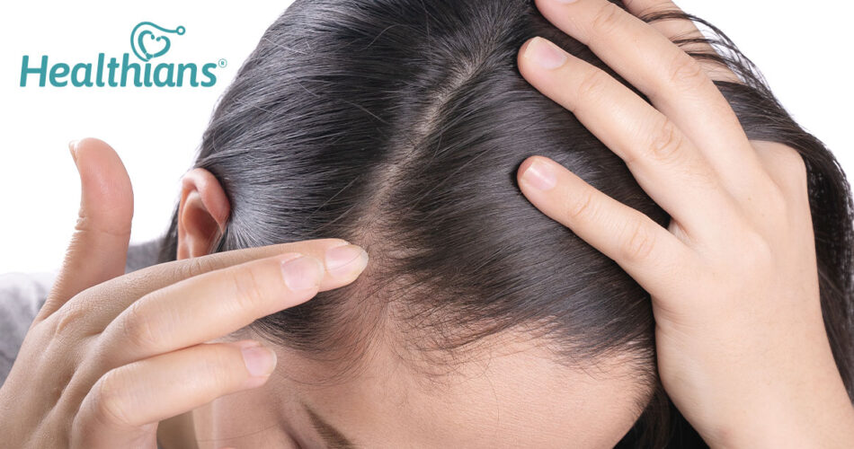 What Is Female Pattern Baldness Know More About Female Hair Loss Healthians Blog
